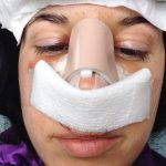 Septoplasty Before And After Photos (4)