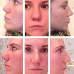 Septoplasty Before And After Photos (7)