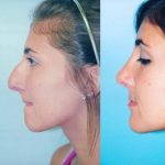 Septorhinoplasty And Rhinoplasty Before And After (12)
