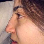 Septorhinoplasty And Rhinoplasty Before And After (7)