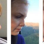 Septorhinoplasty And Rhinoplasty Before And After (9)