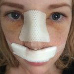 Septorhinoplasty Before And After Photos (1)