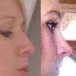 Septorhinoplasty Before And After Photos (8)