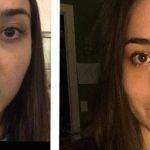 Septorhinoplasty Before And After Photos (9)
