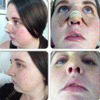 Septorhinoplasty Can Be Performed To Correct A Birth Defect