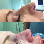 Septorhinoplasty Images (12)