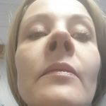 Septorhinoplasty To Improve Breathing Through Your Nose