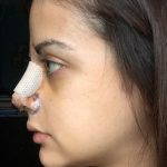 Usually Rhinoplasty Is Very Safe, But Always Is A Delicate Procedure