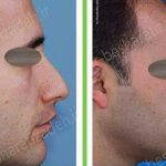What Is Hooked Nose Surgery Photo
