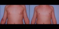 17 or under year old man treated for Male Breast Reduction