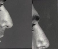 17 or under year old man treated with Rhinoplasty
