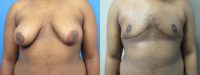 17 or under year old man treated with Gynecomastia Surgery