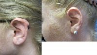 17 or under year old woman treated with Keloid Removal from bilateral ears