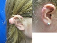 17 or under year old woman treated with keloid removal of bilateral ears