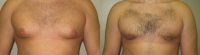 18-24 year old man treated with Vaser Liposuction