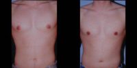 18-24 year old man treated for Male Breast Reduction