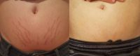 18-24 year old man treated with Stretch Marks Device