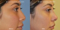 18-24 year old woman treated with Nonsurgical Nose Job
