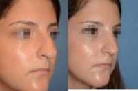 19 year old patient gets customized Rhinoplasty