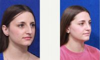 19 Year Old Woman Treated With Rhinoplasty Before By Doctor Ivan Wayne, MD, Oklahoma City Facial Plastic Surgeon