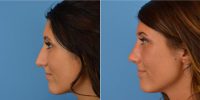 19 Year-old Rhinoplasty Before By Dr. Bradford A. Bader, MD, Plano Facial Plastic Surgeon