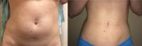 18-24 year old woman treated with Liposuction