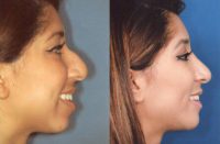 18-24 Year Old Latina Woman Primary Rhinoplasty With Chin Implant