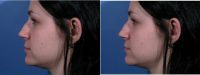 20 Year Old Woman Treated With Rhinoplasty Before With Dr. Mark Samaha, MD, Montreal Facial Plastic Surgeon