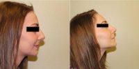 21 Year Old Woman Treated With Rhinoplasty Before By Dr. Jawed Tahery, FRCS, Manchester Otolaryngologist