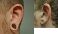 18-24 year old man treated with Ear Lobe Surgery
