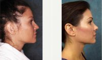 23 Year Old Woman Treated With Rhinoplasty Before By Doctor Frank L. Stile, MD, Las Vegas Plastic Surgeon