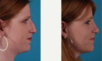 23 Year Old Woman Treated With Rhinoplasty Before With Doctor Steven R. Mobley, MD, Salt Lake City Facial Plastic Surgeon 204