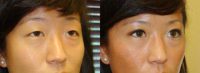 18-24 year old woman treated with Asian Eyelid Surgery