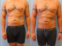 18-24 year old man treated with Liposculpture