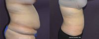 25-35 year old woman treated with Liposuction