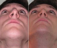 25-34 year old man treated for Nose Surgery