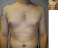 26 year old male who underwent breast reduction for gynecomastia