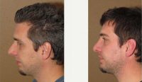 26 Year Old Man Treated With Rhinoplasty Before By Dr. Gregory Turowski, MD, PhD, FACS, Chicago Plastic Surgeon