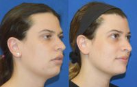 26-year-old woman treated with MTF facial feminization