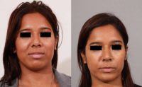 27 year old female who underwent a revision rhinoplasty and chin implant.