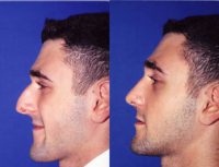 27 Year Old Male treated with Rhinoplasty (Nose Job)
