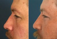 27 Year Old Man Treated With Rhinoplasty Before With Doctor Jonathan Kulbersh, MD, Charlotte Facial Plastic Surgeon