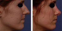 27 Year Old Woman Treated With Rhinoplasty Before By Doctor Raymond Goh, MBBS (Hons), FRACS (Plast), Brisbane Plastic Surgeon