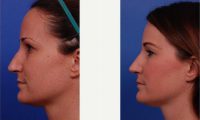 27 Year Old Woman Treated With Rhinoplasty Before By Dr. Thomas J. Walker, MD, FACS, Atlanta Facial Plastic Surgeon