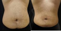 25-34 year old man treated with Smart Lipo