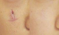 25-34 year old woman treated with Scar Removal