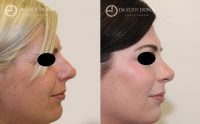 28 Year Old Woman Treated With Rhinoplasty Before By Doctor Eddy Dona, MBBS, FRACS, Sydney Plastic Surgeon