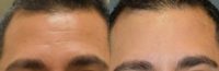 25-34 year old man treated with Botox