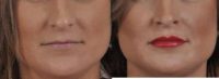 25-34 year old woman treated with Dermal Fillers and Injectables