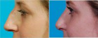 29 Year Old Woman Treated With Rhinoplasty Before With Doctor Jerold Olson, MD, Tucson Facial Plastic Surgeon